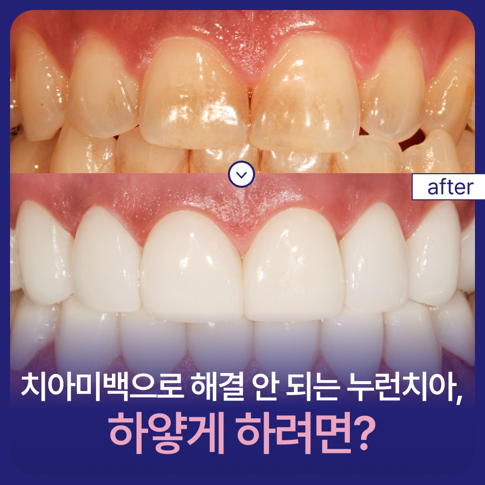 치아미백으로 해결 안 되는 누런치아, 하얗게 하려면? 관련 이미지 1