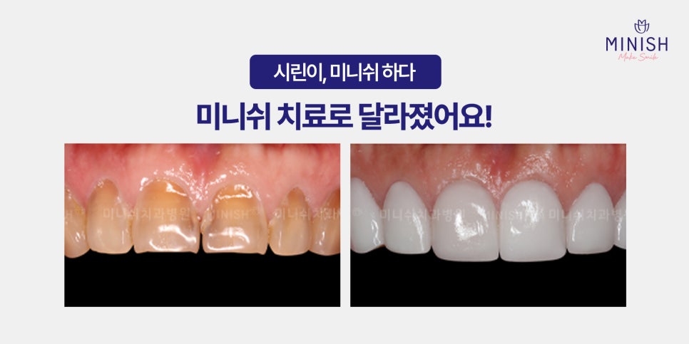시린이 치료로 주목받는 미니쉬! 관련 이미지 6