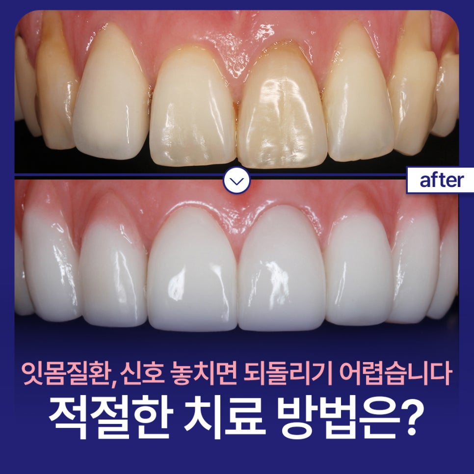 If You Miss the Warning Signs of Gum Disease, It Becomes Hard to Reverse. What Is the Right Treatment Method? image 1