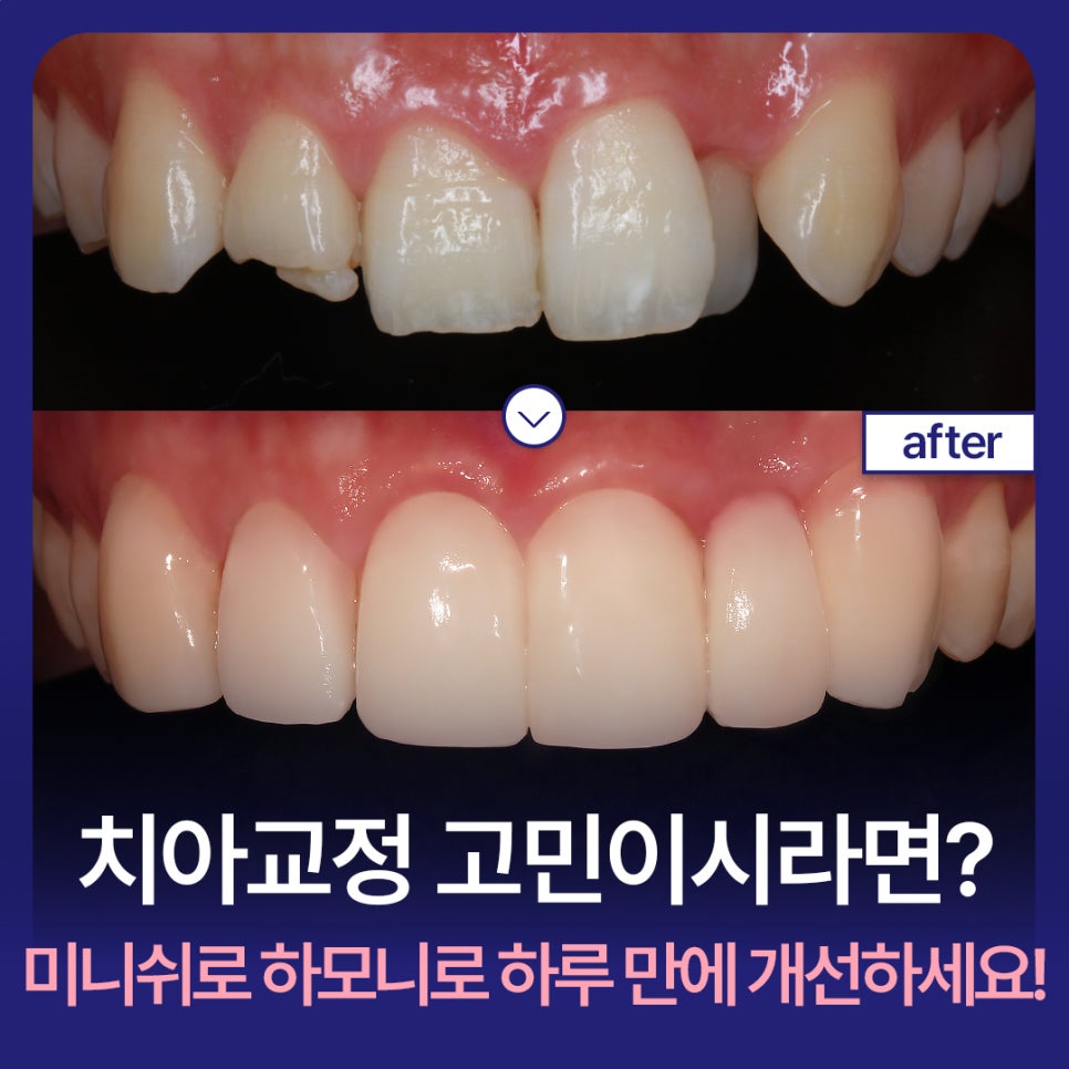 Worried About Orthodontics? Improve in One Day with Minish Harmony! image 1
