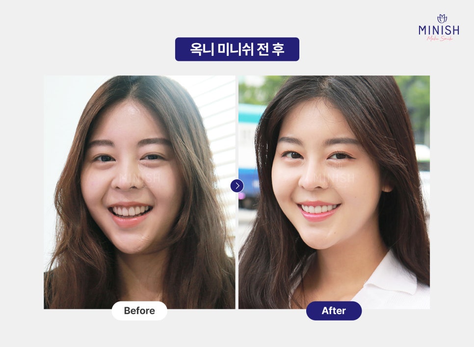 들어간 입, 합죽이 입 옥니 교정 심미와 기능 회복을 위한 최선의 방법은? 관련 이미지 5