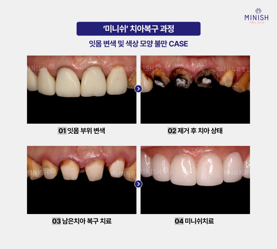 Laminates Retreatment: Be Sure to Know This Before You Proceed! image 8