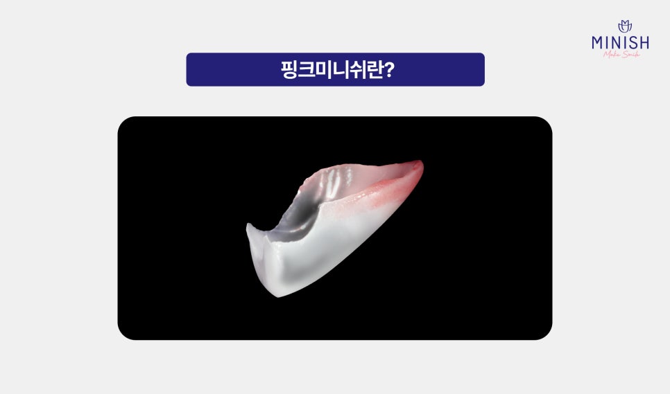 From Front Teeth to Molars, Which Minish Is Right for My Dental Condition? image 5