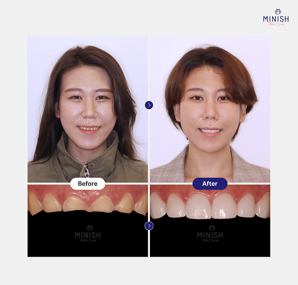방치하면 큰일! 치아부식 증상 원인 치료 방법엔? 듀얼미니쉬 관련 이미지 4