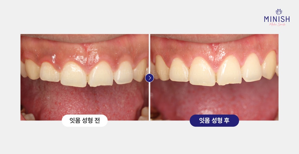 웃을 때 잇몸 과다 노출, 거미스마일 잇몸성형 알아보신다면? 관련 이미지 5