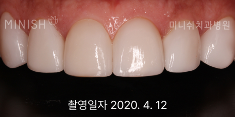 누런치아, 치아 미백으로 해결되지 않을 땐? 관련 이미지 9