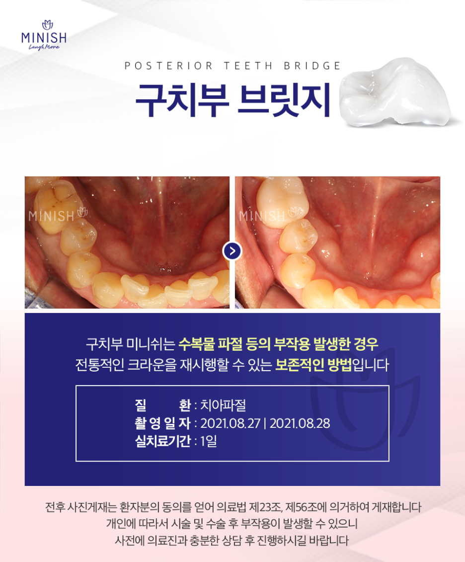 논현동 라미네이트 진행을 고민하고 있다면 건강한 미니쉬로 관련 이미지 4