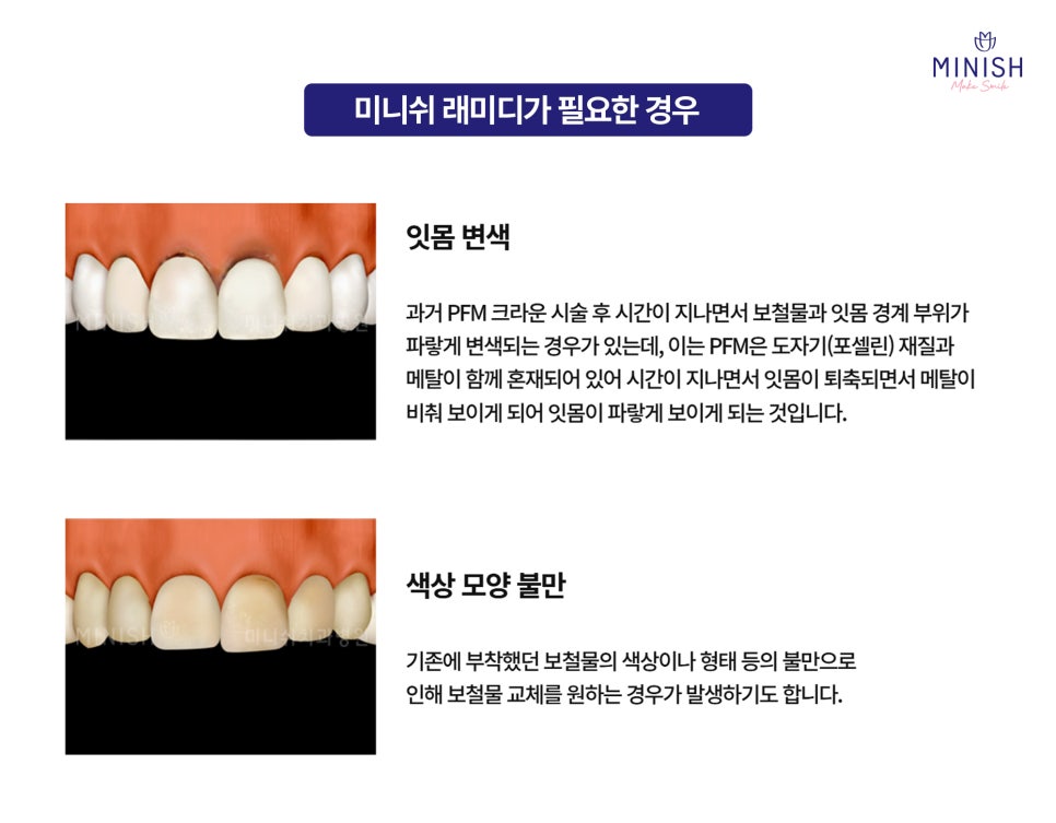 A Complete Guide to the Minish Program That Fits My Teeth image 6