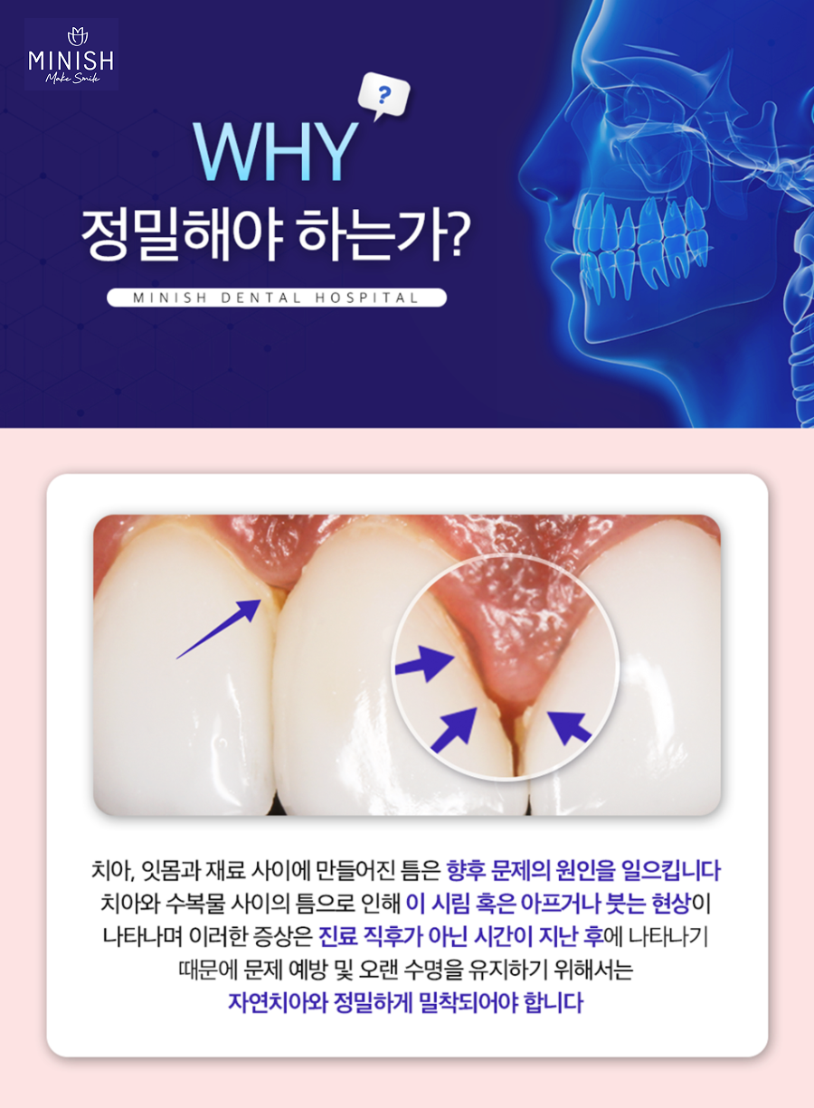 미용 목적의 라미네이트와 치료 목적의 미니쉬 차이점은? 관련 이미지 3