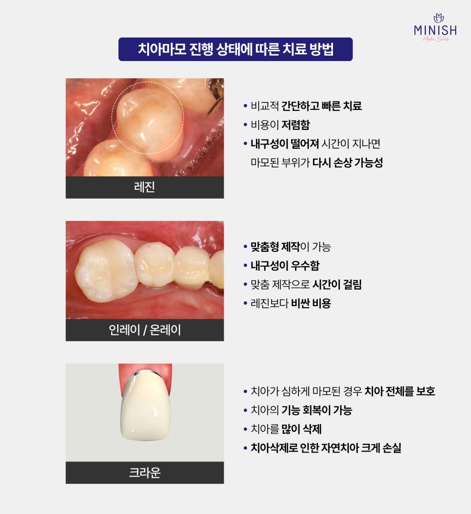 Regret It If You Leave Tooth Wear Untreated! What Are the Ways to Restore It Healthily? image 4