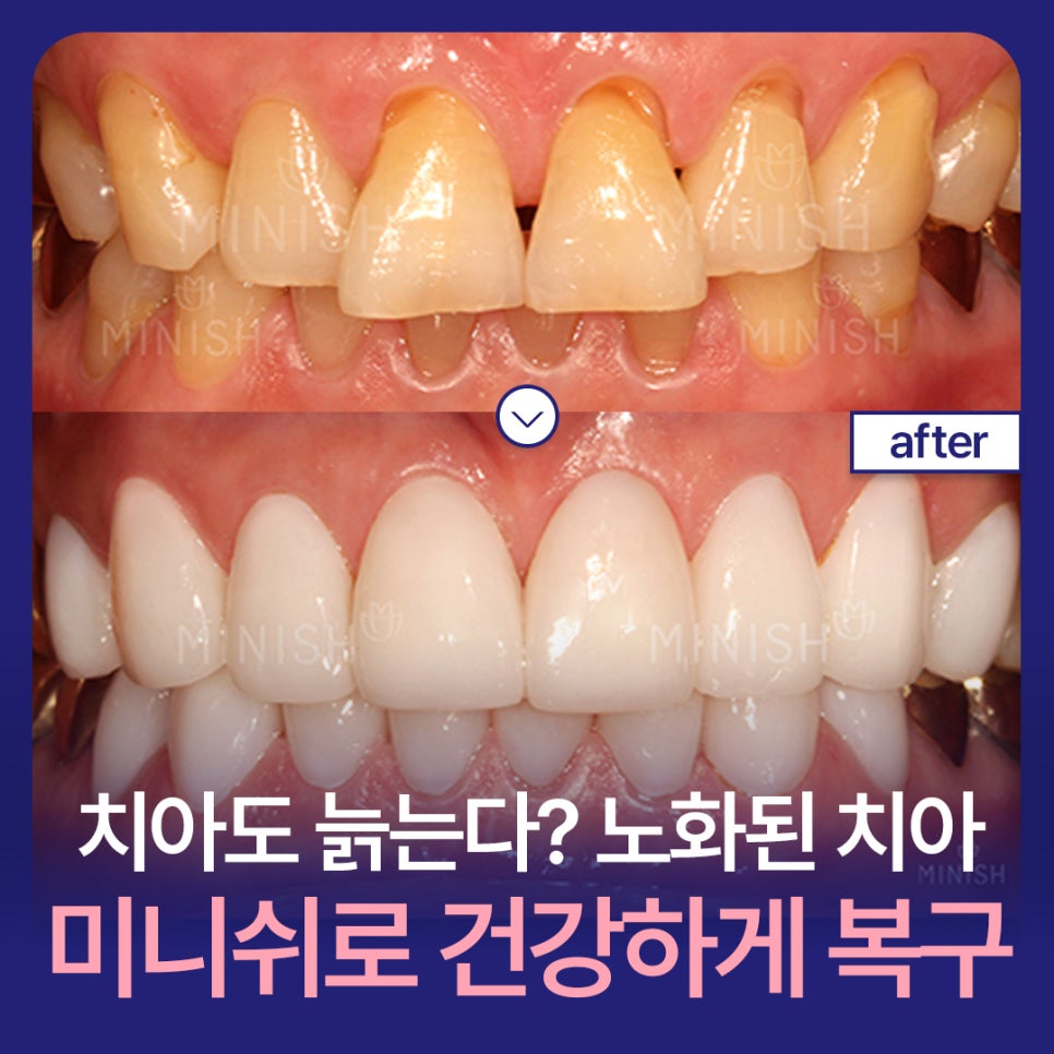 [Tooth Aging] Do Teeth Age, Too? Restoring Them Healthily with Minishe image 1
