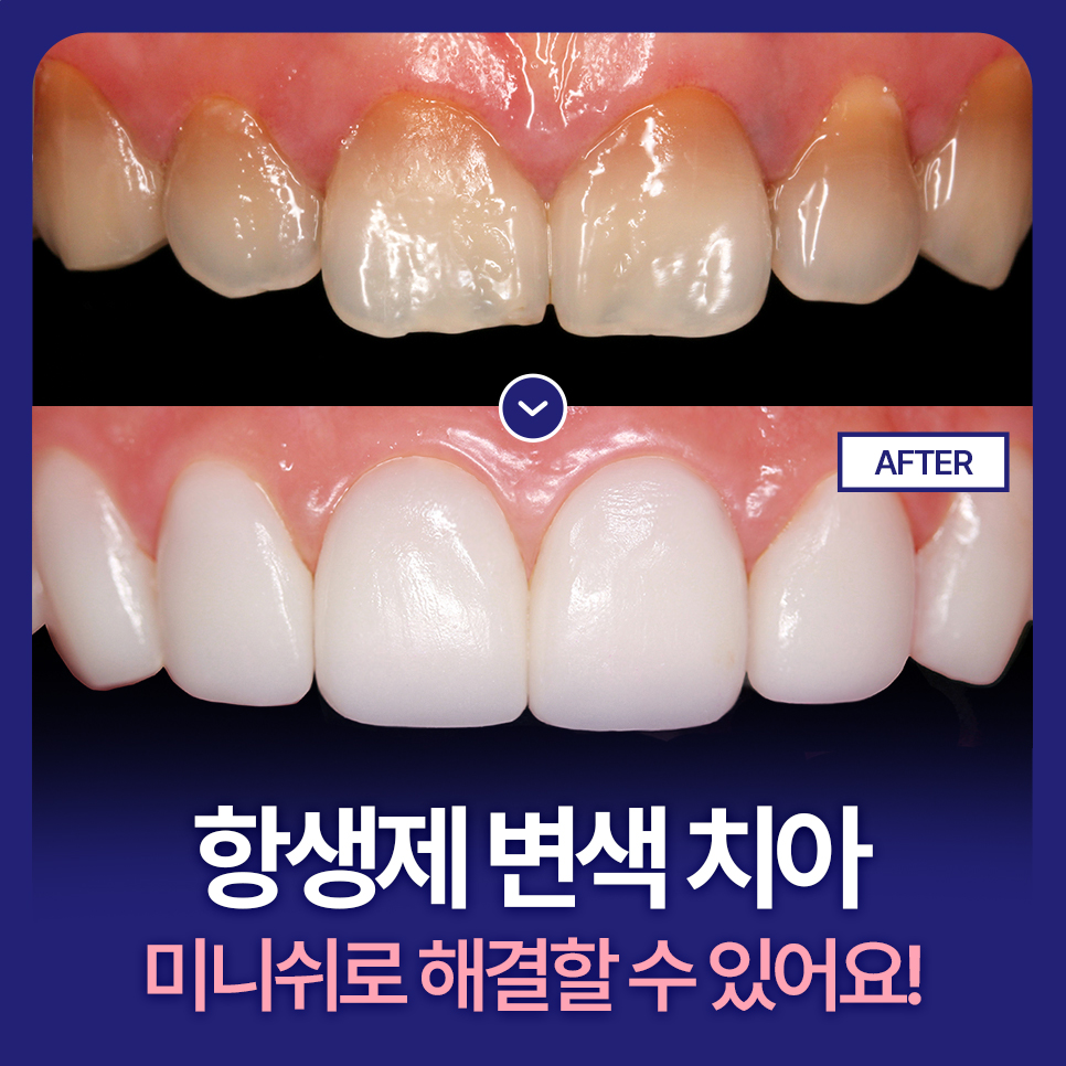 Antibiotic-Discolored Teeth Can Be Treated with MINISH! image 1