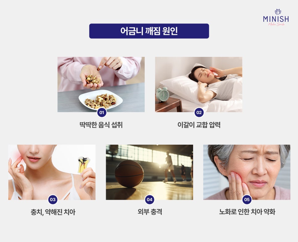 [Cracked Molar] Sudden Pain in Everyday Life, from Causes to Treatment Methods image 2