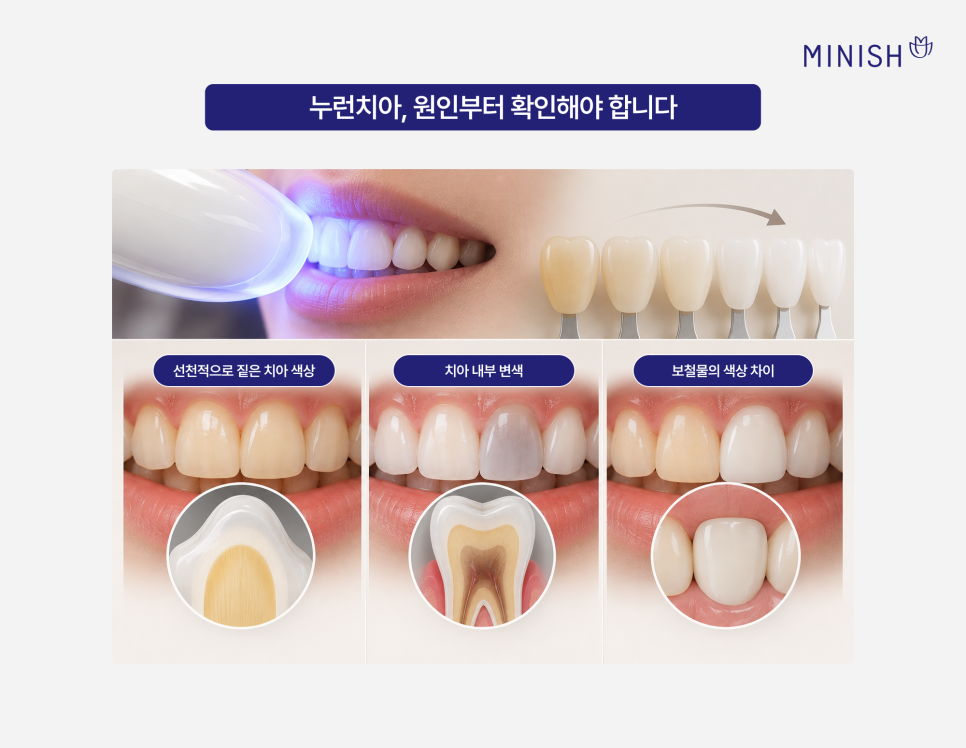 치아미백으로 해결 안 되는 누런치아, 하얗게 하려면? 관련 이미지 3