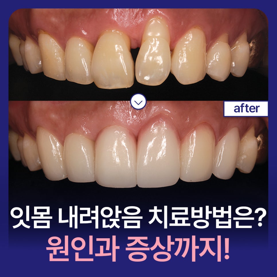 잇몸 내려앉음 치료 방법은? 원인과 증상까지! 관련 이미지 1