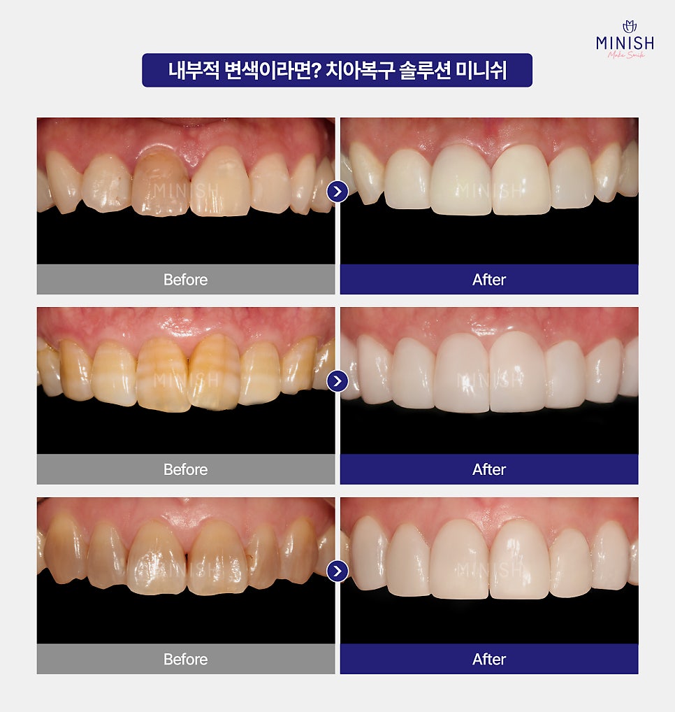 Yellowed Teeth and Discoloration: From the Cause to the Right Improvement Method for Me image 5