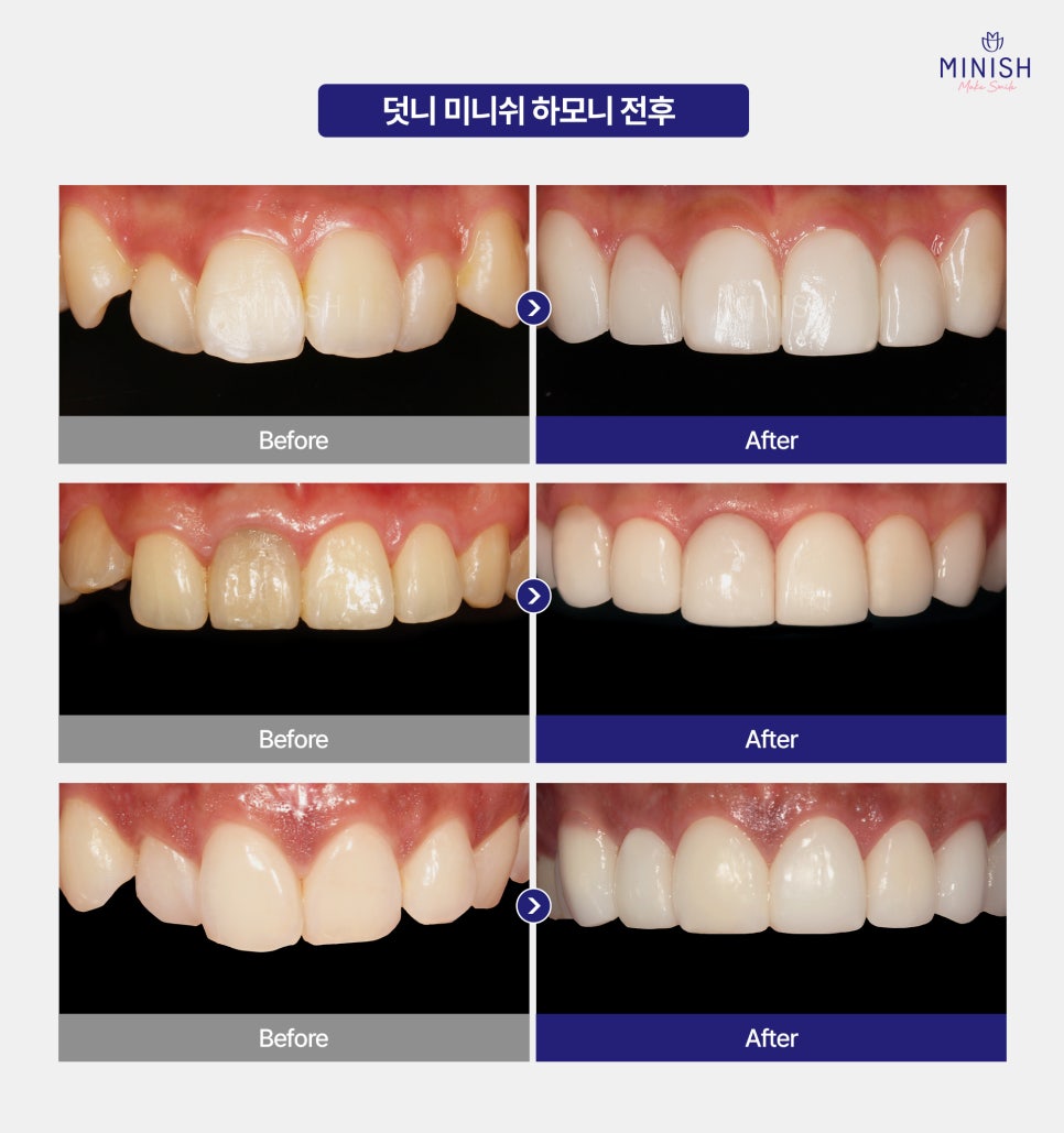 Complex About Crooked Canines? Improve Quickly Without Orthodontics with Minishe Harmony! image 5