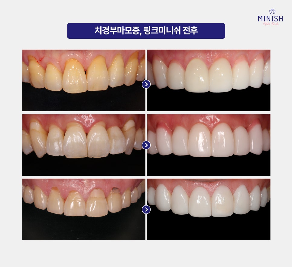 Cervical Abrasion, Causes of Exposed Tooth Roots, and Treatment for Gum Indentations image 8
