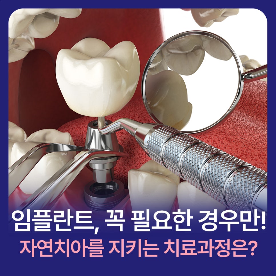Implants, Only When Truly Necessary! Minish Dental Hospital’s Treatment Process for Protecting Natural Teeth image 1