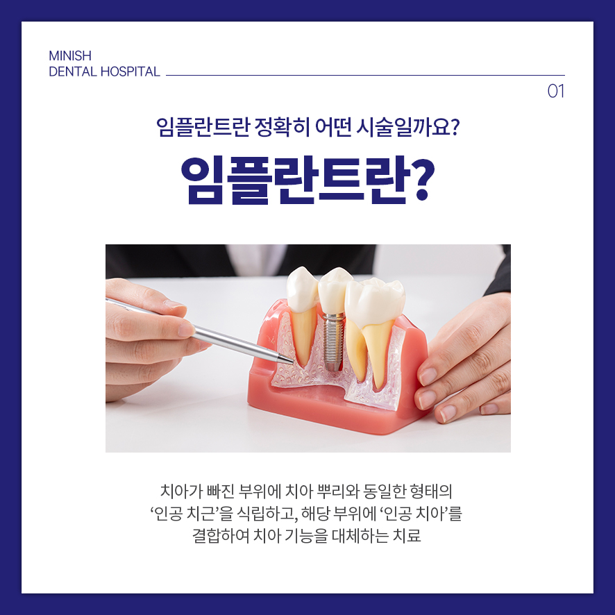 '임플란트'의 거의 모든 것 관련 이미지 6