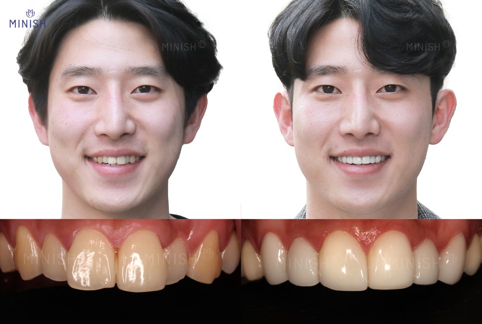 원데이라미네이트와 미니쉬 원데이 시스템 왜 다르고, 무엇이 나을까? 관련 이미지 6