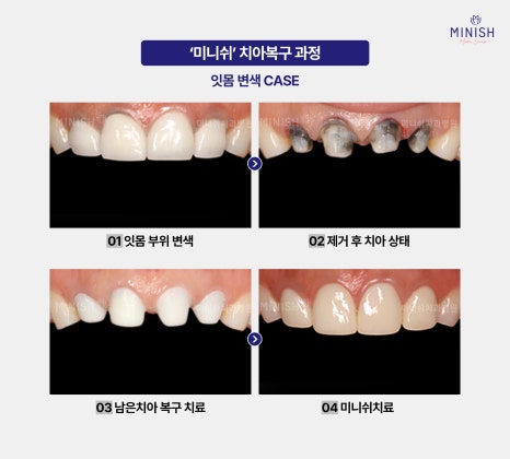 When Crown Retreatment Is Needed: The Tooth Restoration Solution Minish image 9