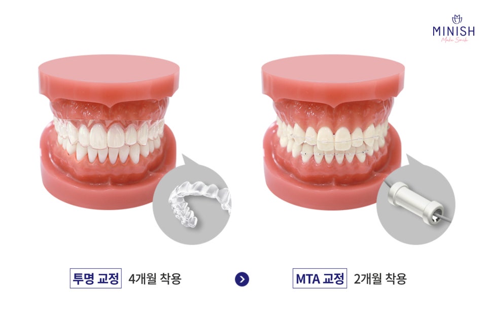 Types of Orthodontic Treatment at Minish Dental Hospital and How to Improve Aesthetics Too! image 4