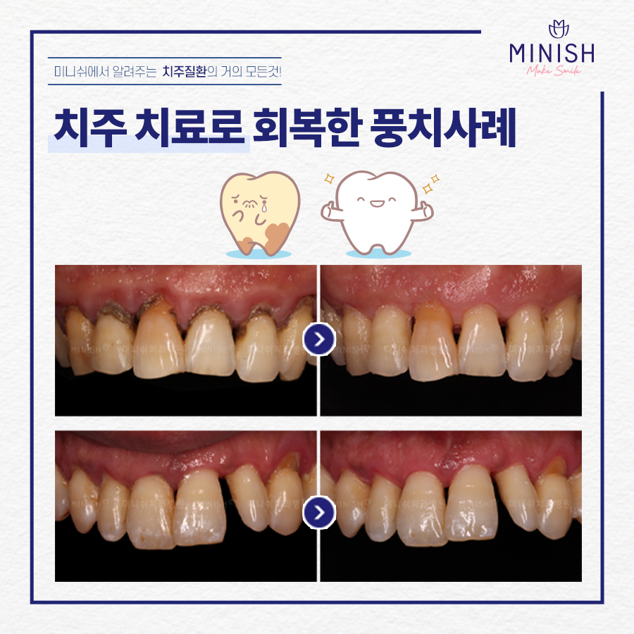 '치주질환'의 거의 모든 것 +잇몸/풍치 자가 체크 관련 이미지 9
