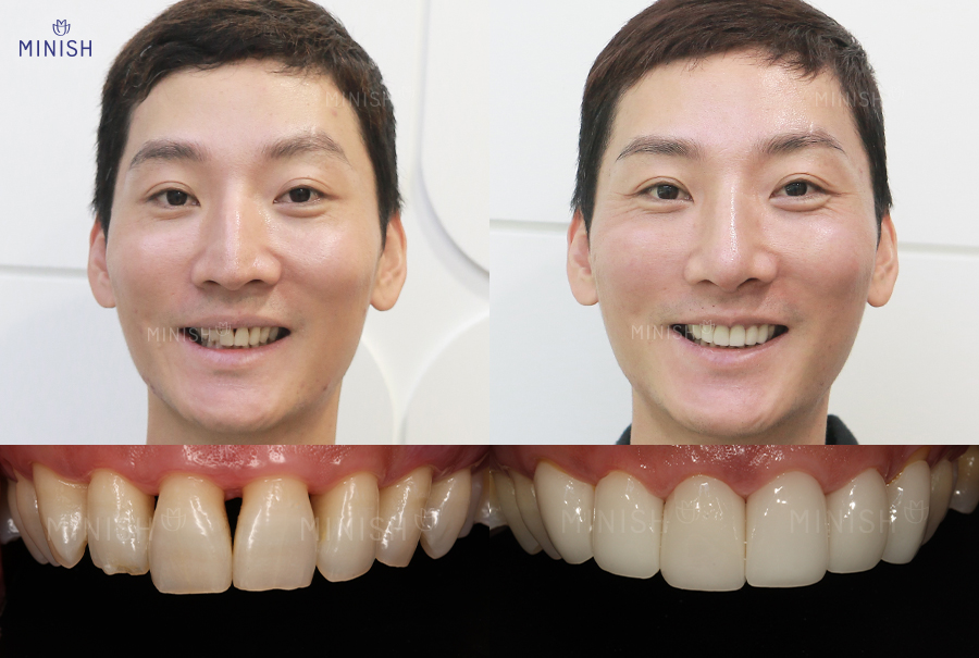 통증 부르는 부은 잇몸 멈춰! 건강한 미니쉬로 해결하세요 관련 이미지 8