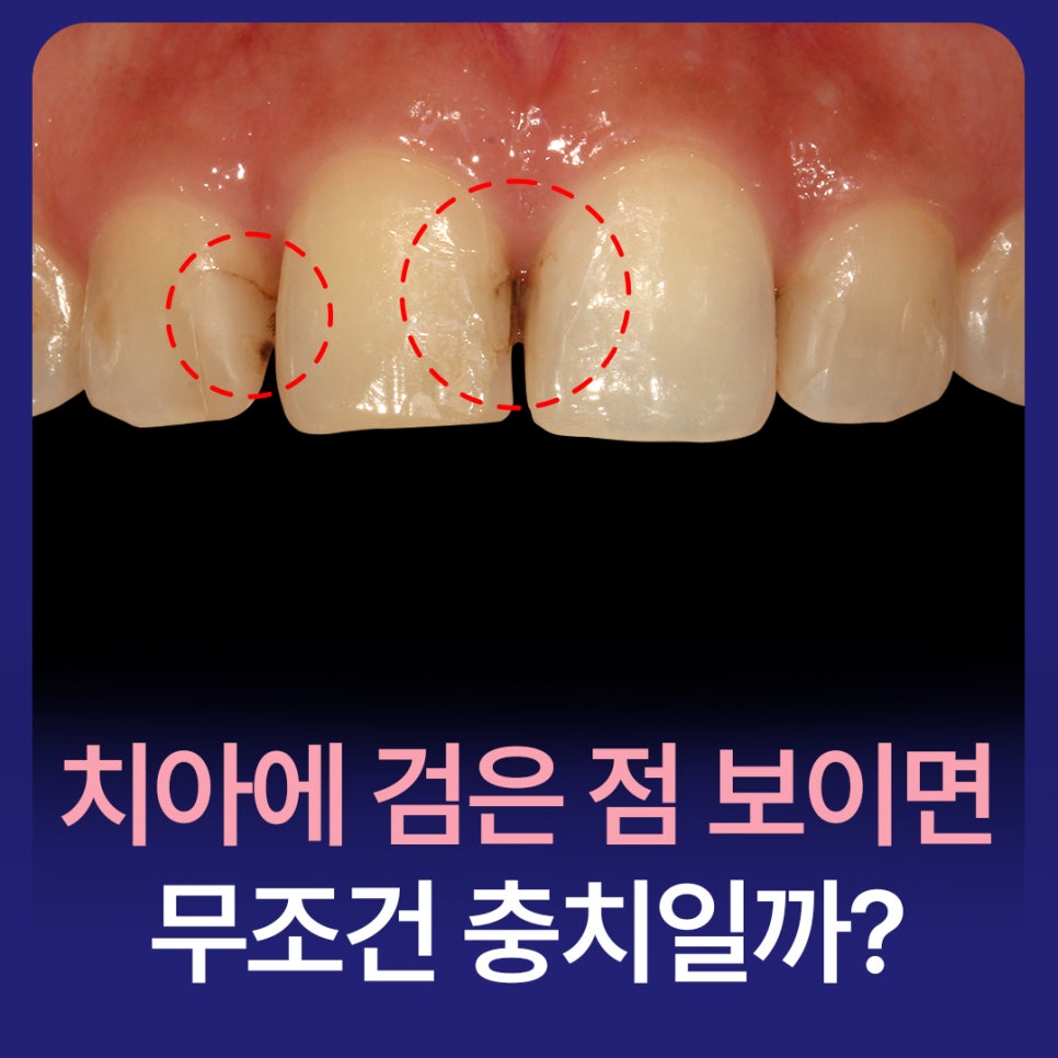 If You See a Black Spot on a Tooth, Is It Definitely a Cavity? image 1