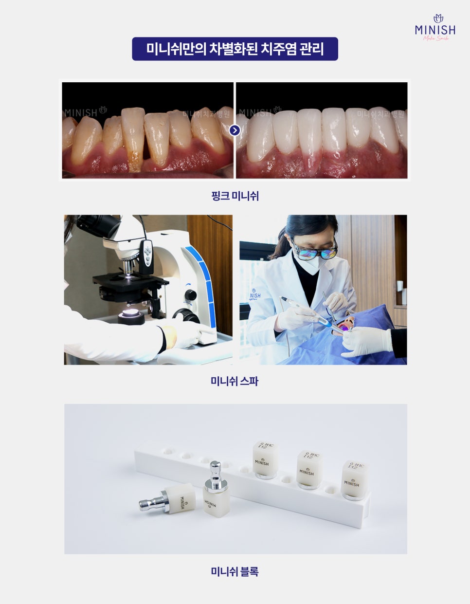 치주염 치료, 미니쉬가 제안하는 건강한 치아복구 솔루션 관련 이미지 7