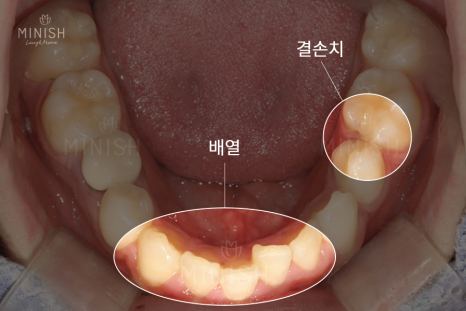 가평엄마 아들의 결손치, 미니쉬로 복원! [엄마는 예뻤다] 관련 이미지 13
