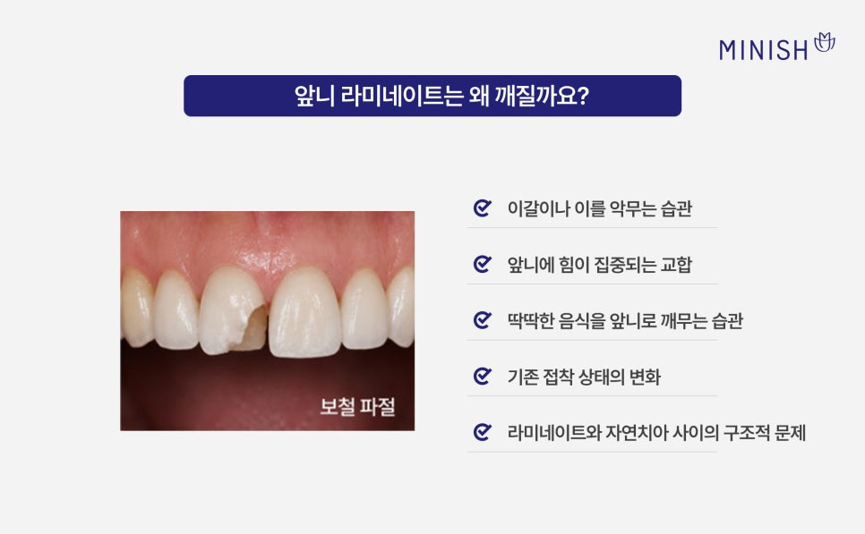 앞니 라미네이트 깨짐, 재치료가 필요하다면? 관련 이미지 2