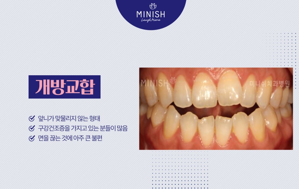 부정교합종류, 하루만에 교정할 수 있는 방법도 있을까? 관련 이미지 4