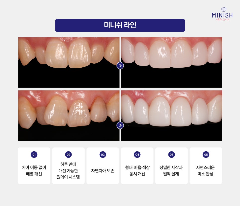 A Complete Guide to Adult Orthodontic Types: Which Method Is Right for Me? image 5