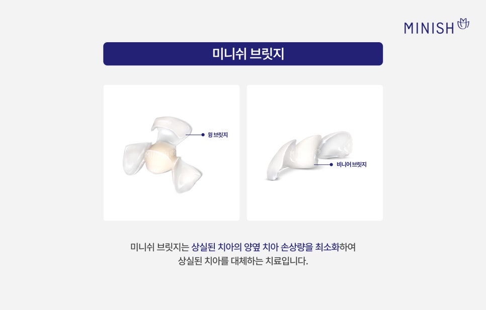 치아 브릿지, 자연치아를 보존하는 미니쉬 브릿지 관련 이미지 4