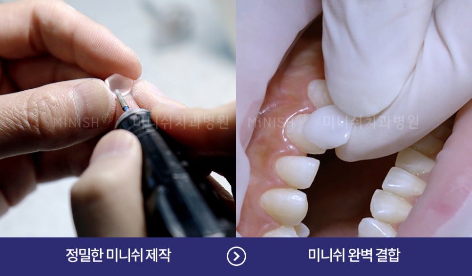 이가 시린 이유와 시린이 해결 방법 관련 이미지 7