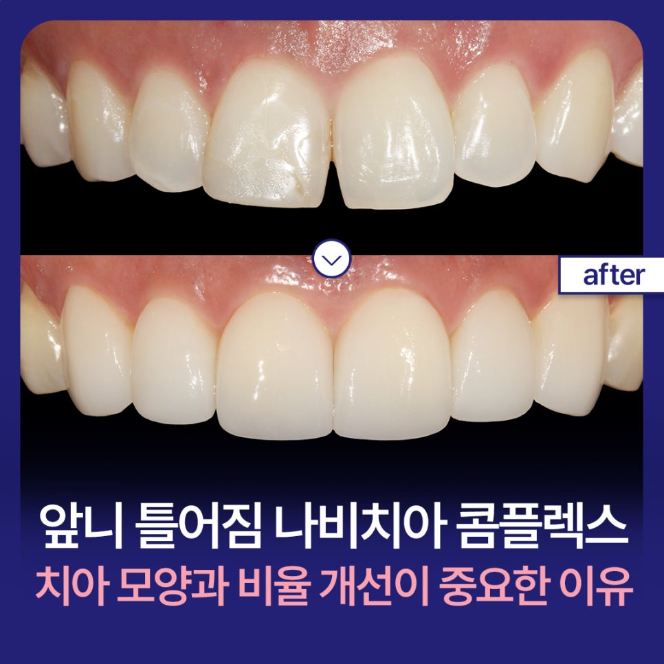Crooked Front Teeth and the Butterfly Teeth Complex: Why Improving Tooth Shape and Proportions Matters / Minish Line image 1