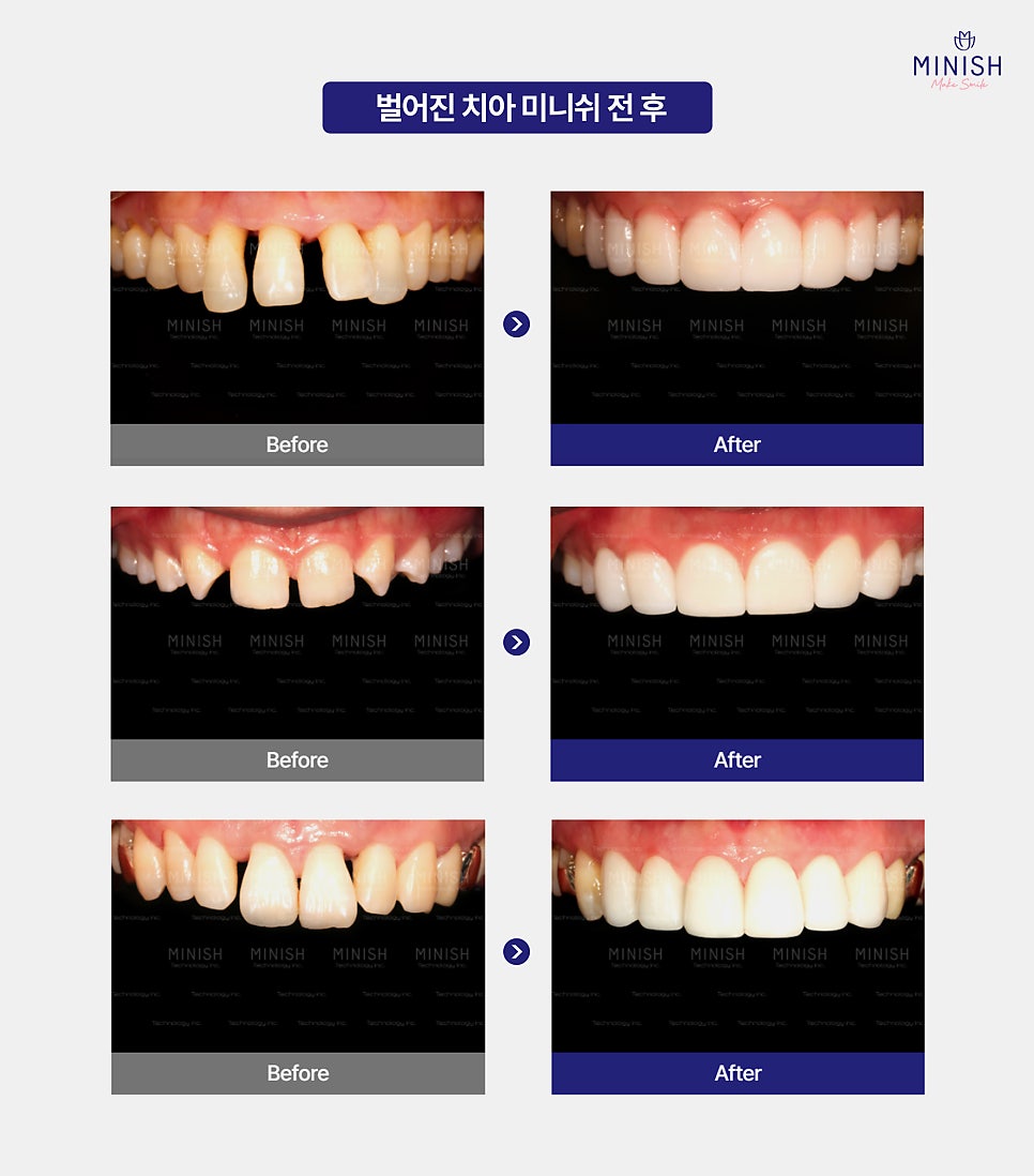 Don't Leave Gapped Teeth Visible When You Smile—Transform Them with Minishe! image 4