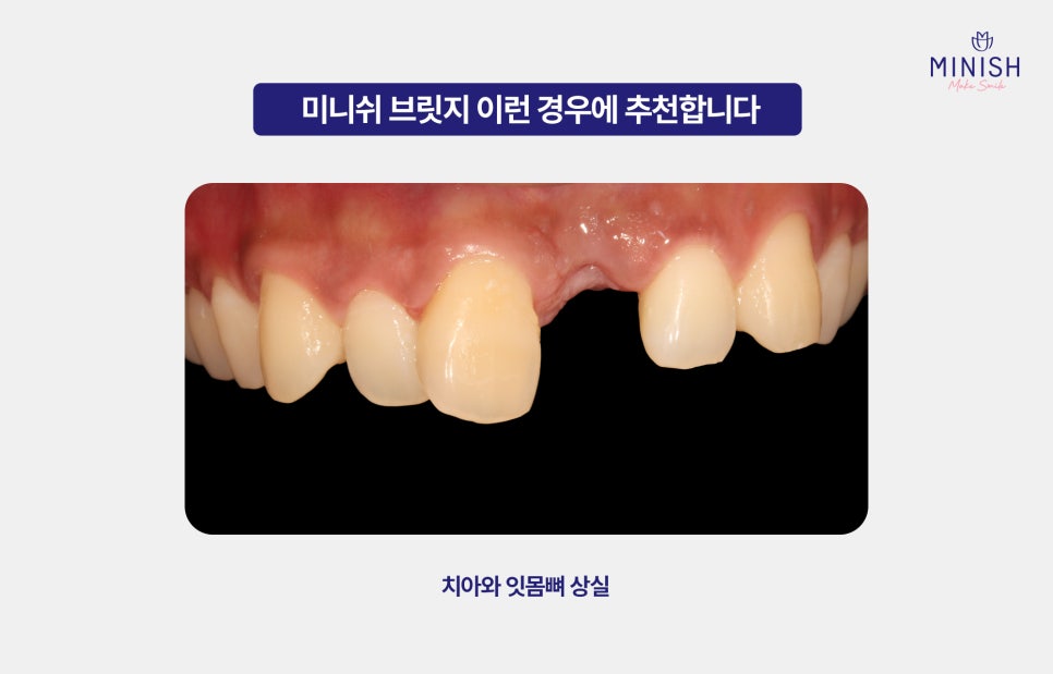 From Front Teeth to Molars, Which Minish Is Right for My Dental Condition? image 9
