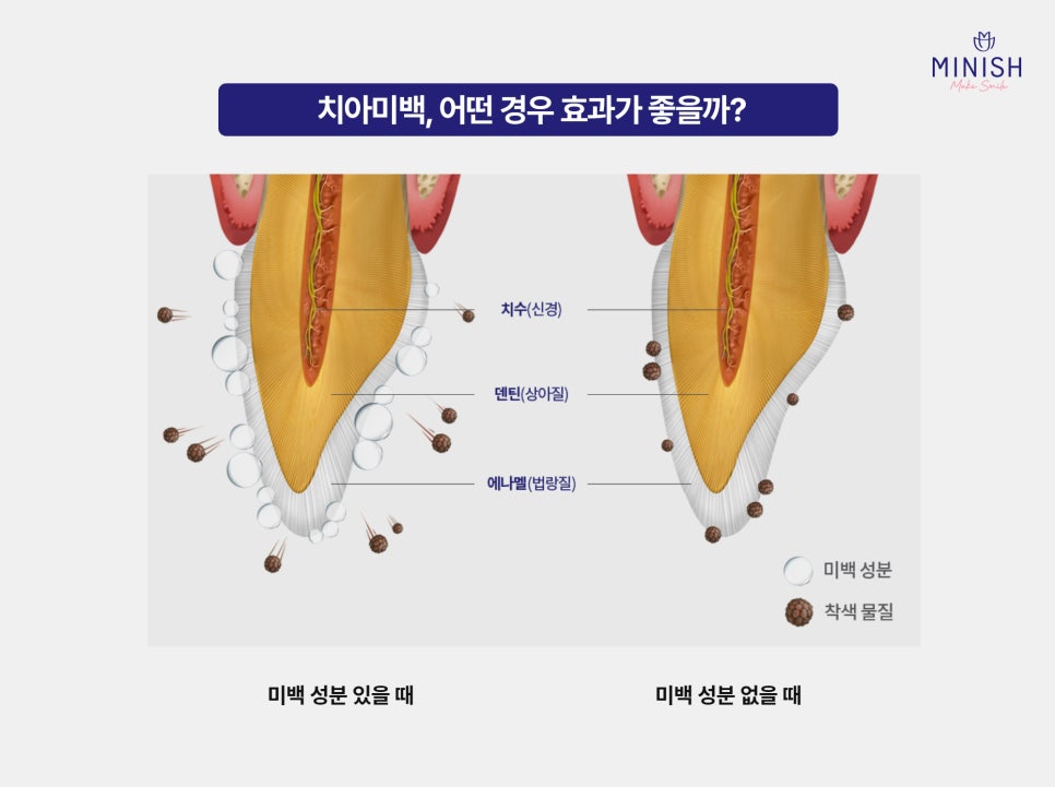 누런 치아 착색 원인부터 해결법까지, 치아미백치과 선택 전 필독! 관련 이미지 3
