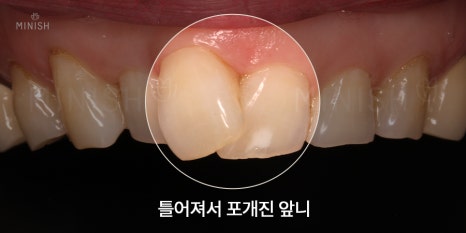 틀어진 앞니 하루만에 해결! (미니쉬, 라미네이트, 부분교정) 관련 이미지 7