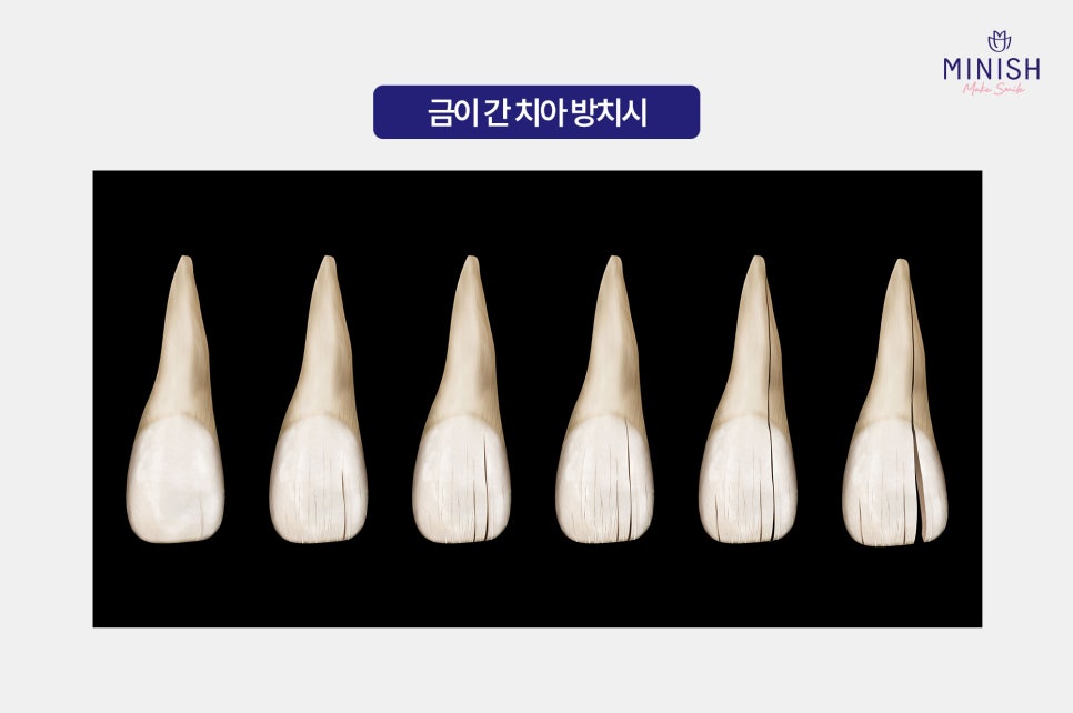 Cracked Teeth, from Cause to Treatment! How to Regain Healthy Teeth image 4