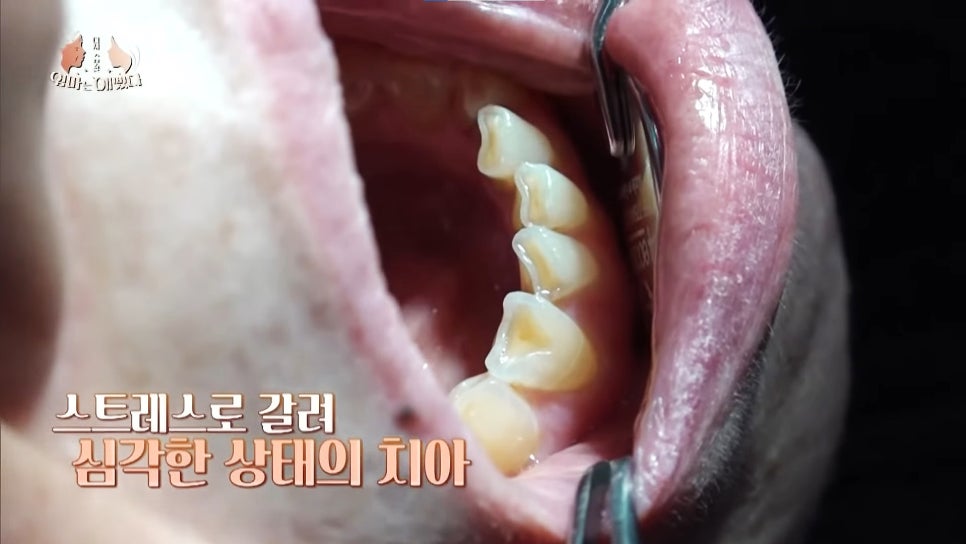 천안엄마의 치아노화, 미니쉬로 치아코팅하다 [엄마는예뻤다] 관련 이미지 7