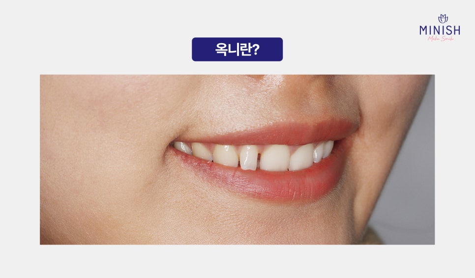 들어간 입, 합죽이 입 옥니 교정 심미와 기능 회복을 위한 최선의 방법은? 관련 이미지 2