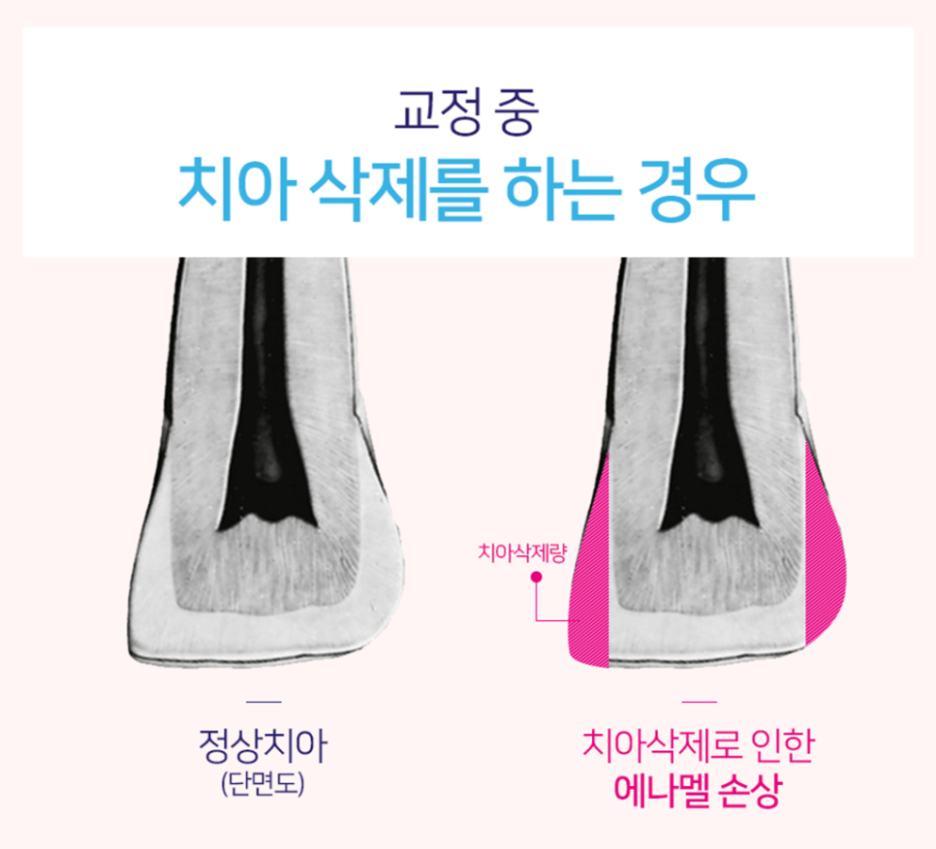 Is It Possible to Straighten Teeth in Just One Day? image 6
