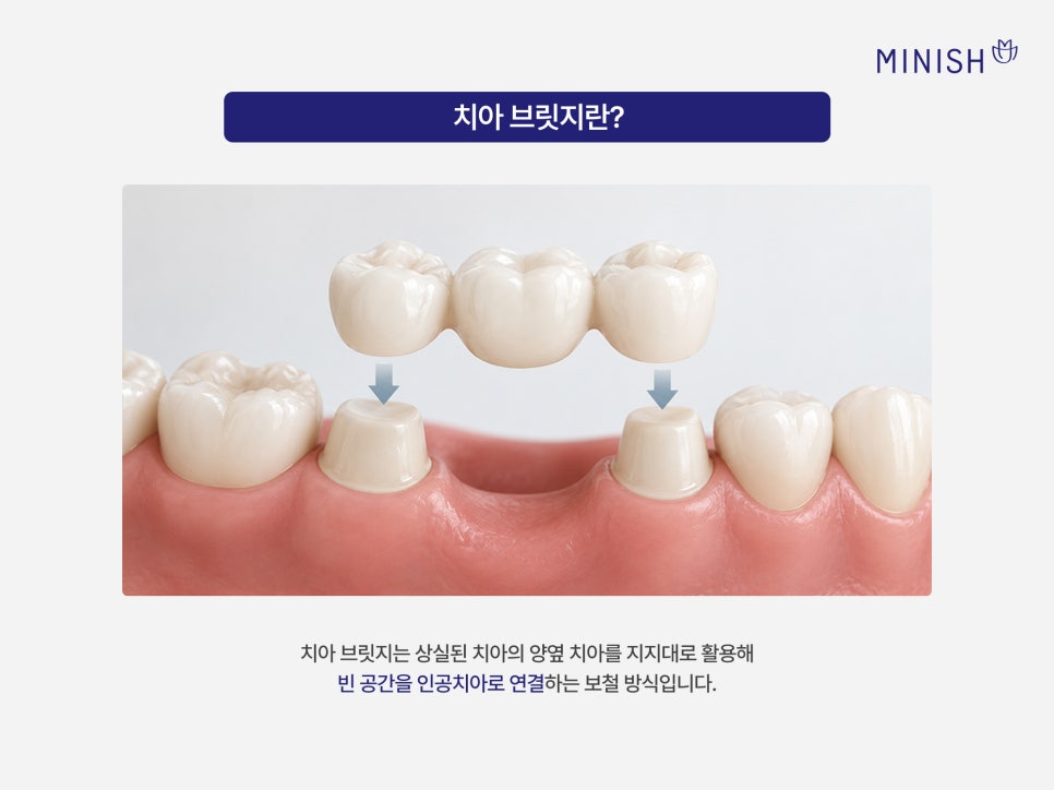 치아 브릿지, 자연치아를 보존하는 미니쉬 브릿지 관련 이미지 2