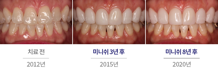 경기도엄마의 스트레스, 치아를 망치다 [엄마는예뻤다] 관련 이미지 8