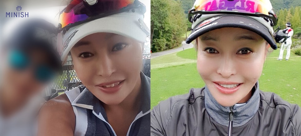 강남치과에서 큰앞니 치료하고 미소를 되찾다! 관련 이미지 9