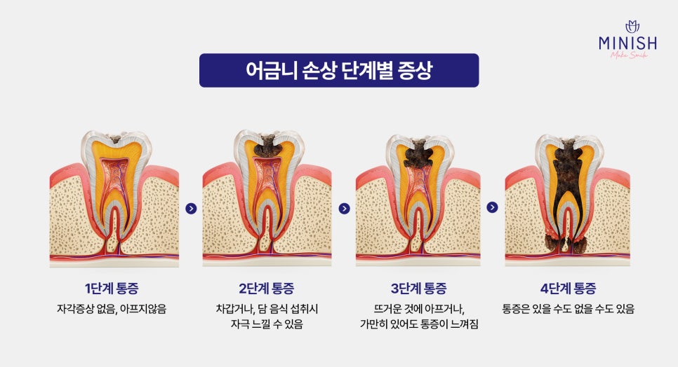Don’t Ignore Molar Pain! Molar Minishe Can Restore Them Healthily image 3